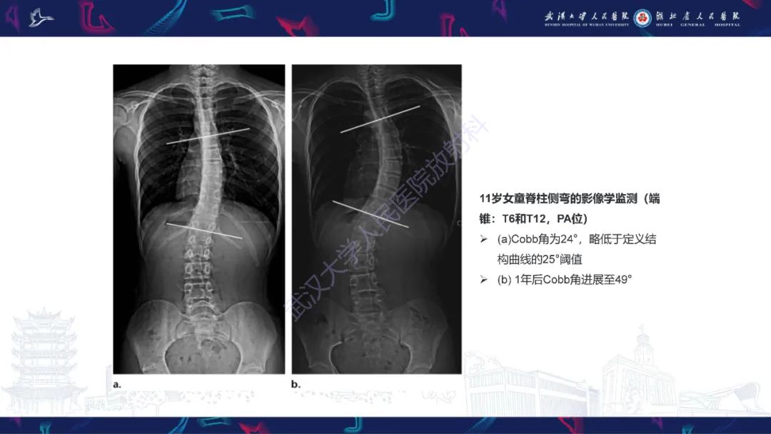 影像PPT - 【PPT】脊柱侧弯影像学评估-30