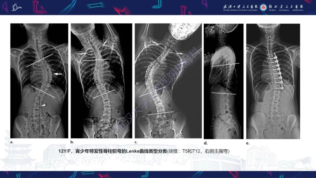 影像PPT - 【PPT】脊柱侧弯影像学评估-33