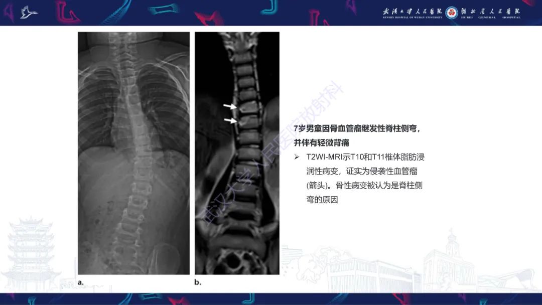 影像PPT - 【PPT】脊柱侧弯影像学评估-35