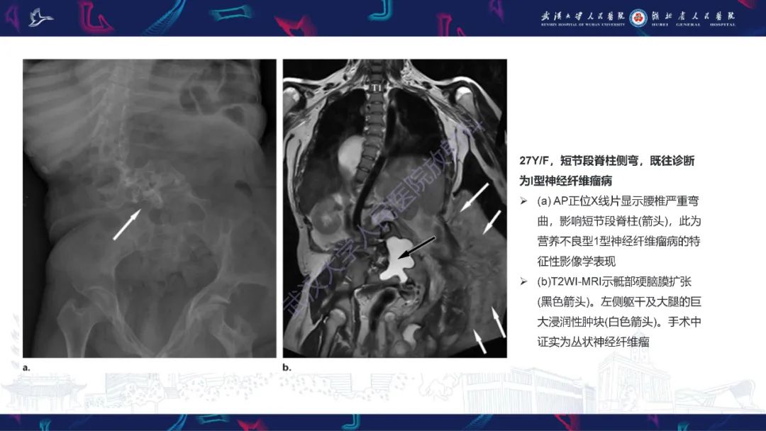 影像PPT - 【PPT】脊柱侧弯影像学评估-36