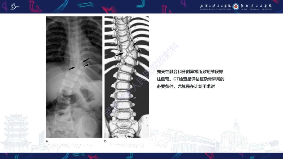 影像PPT - 【PPT】脊柱侧弯影像学评估-37