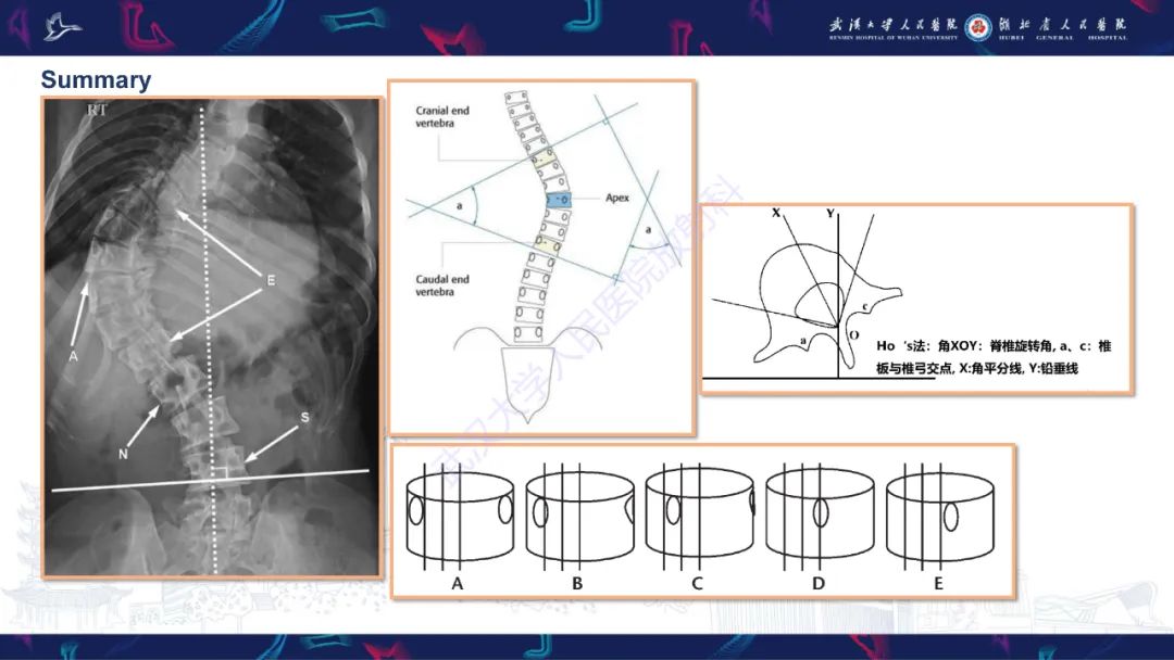 影像PPT - 【PPT】脊柱侧弯影像学评估-41