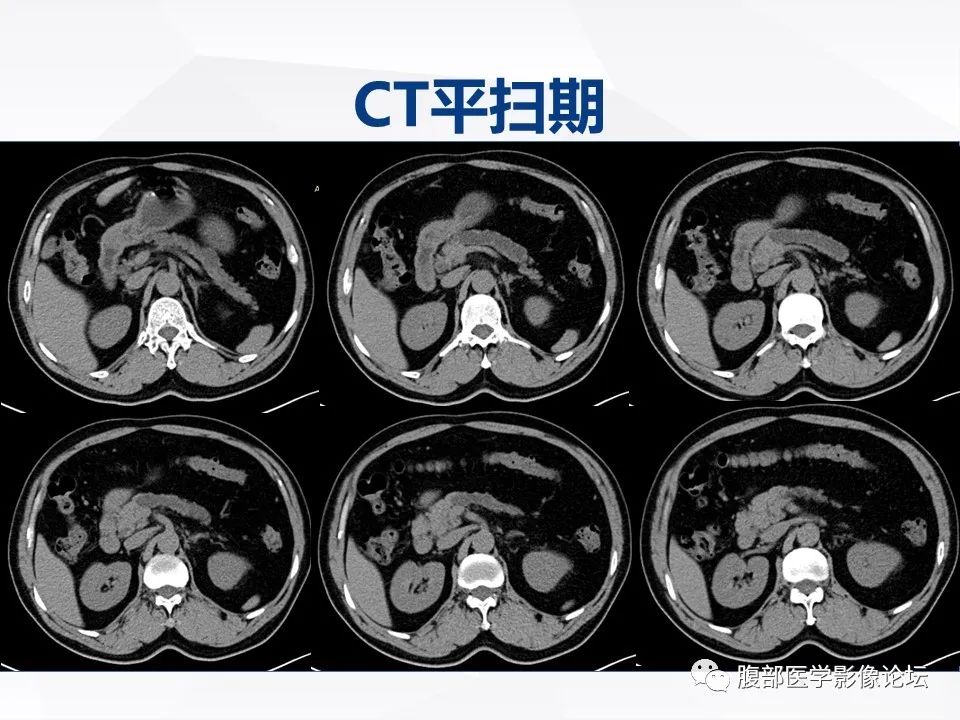 影像PPT - 【病例】胰腺导管内神经内分泌肿瘤1例CT及MR-3