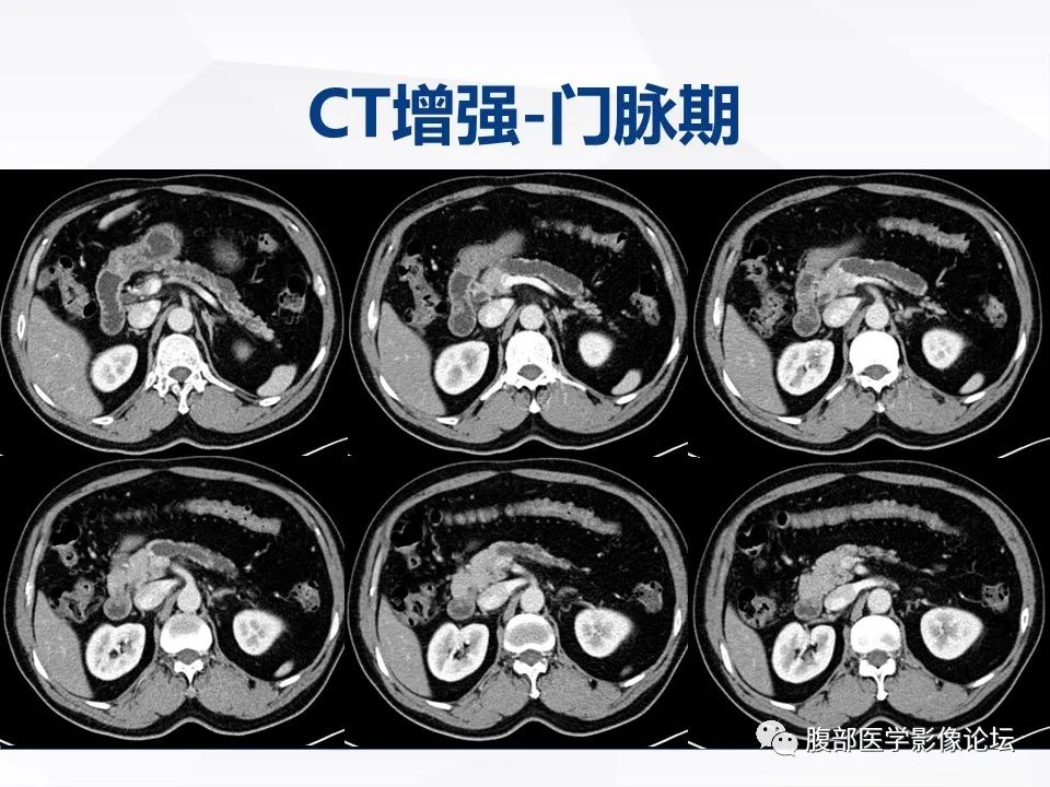 影像PPT - 【病例】胰腺导管内神经内分泌肿瘤1例CT及MR-5