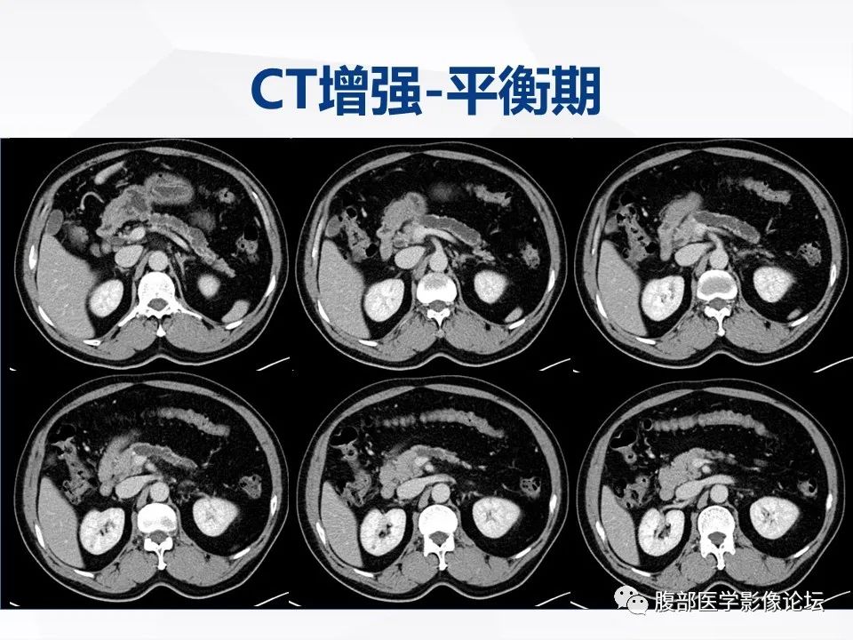 影像PPT - 【病例】胰腺导管内神经内分泌肿瘤1例CT及MR-6
