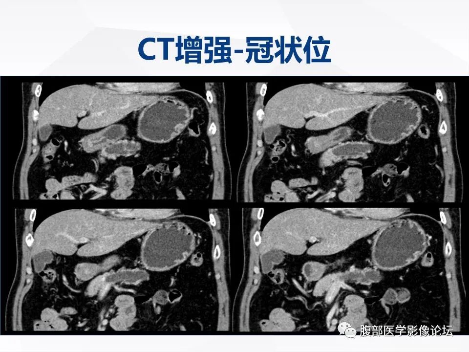 影像PPT - 【病例】胰腺导管内神经内分泌肿瘤1例CT及MR-7