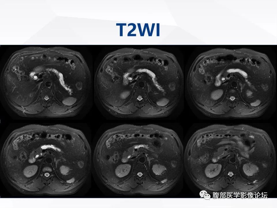 影像PPT - 【病例】胰腺导管内神经内分泌肿瘤1例CT及MR-8