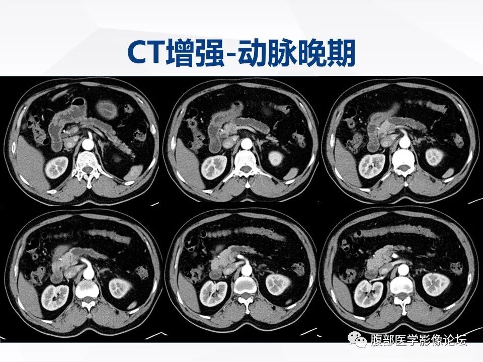 影像PPT - 【病例】胰腺导管内神经内分泌肿瘤1例CT及MR-4