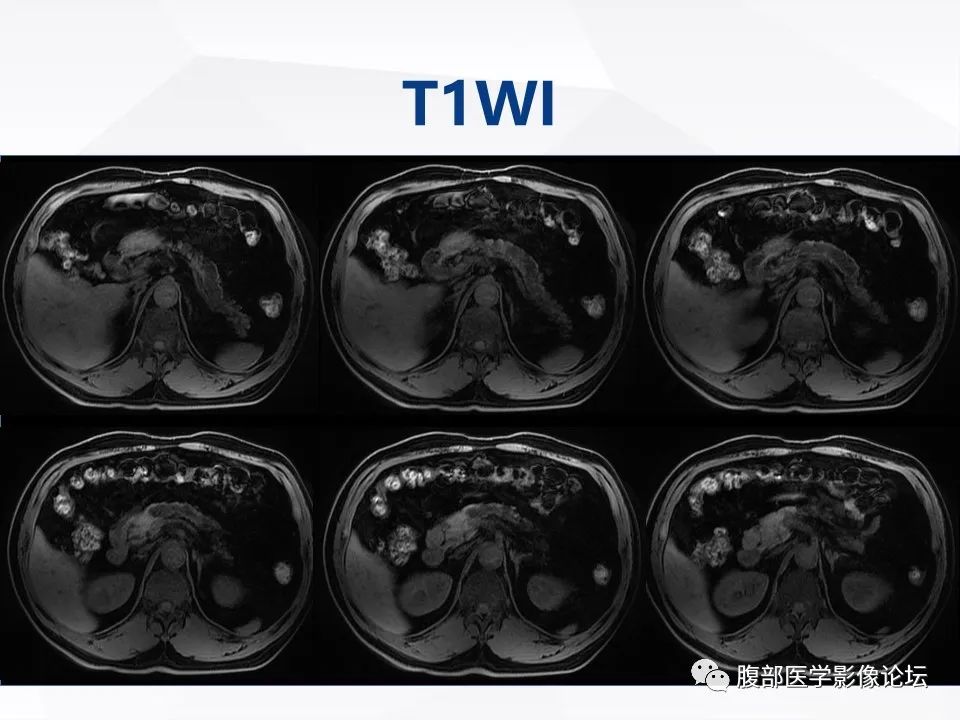 影像PPT - 【病例】胰腺导管内神经内分泌肿瘤1例CT及MR-9