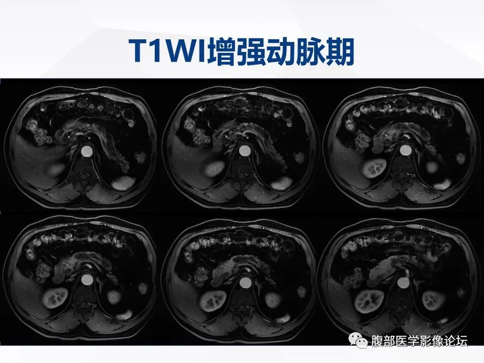 影像PPT - 【病例】胰腺导管内神经内分泌肿瘤1例CT及MR-10