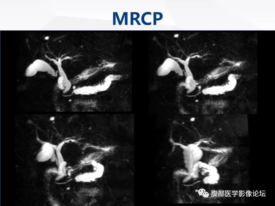 影像PPT - 【病例】胰腺导管内神经内分泌肿瘤1例CT及MR-16