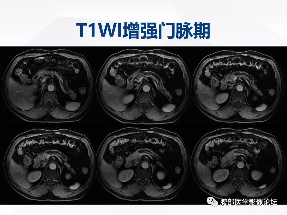 影像PPT - 【病例】胰腺导管内神经内分泌肿瘤1例CT及MR-11