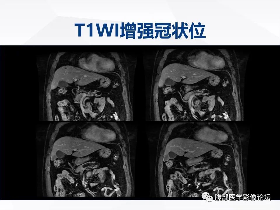 影像PPT - 【病例】胰腺导管内神经内分泌肿瘤1例CT及MR-14