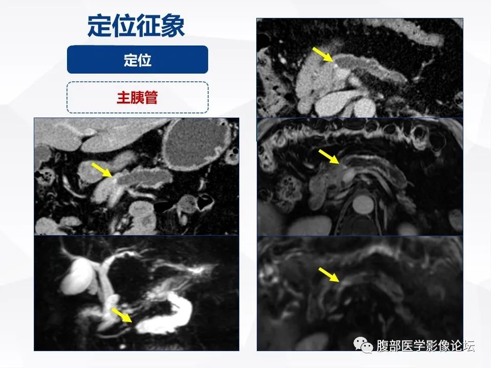 影像PPT - 【病例】胰腺导管内神经内分泌肿瘤1例CT及MR-20