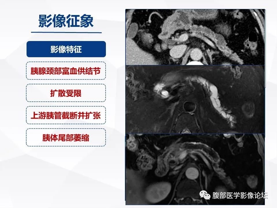 影像PPT - 【病例】胰腺导管内神经内分泌肿瘤1例CT及MR-21