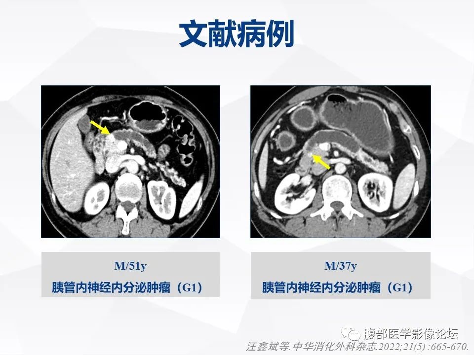 影像PPT - 【病例】胰腺导管内神经内分泌肿瘤1例CT及MR-24
