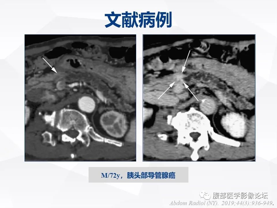 影像PPT - 【病例】胰腺导管内神经内分泌肿瘤1例CT及MR-30