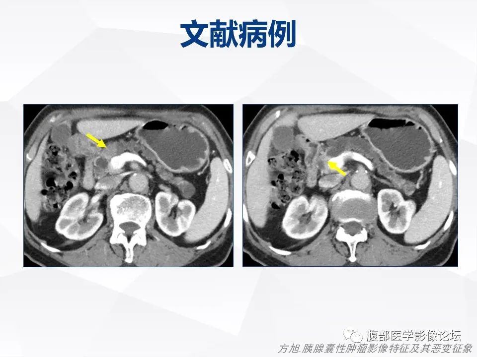 影像PPT - 【病例】胰腺导管内神经内分泌肿瘤1例CT及MR-26