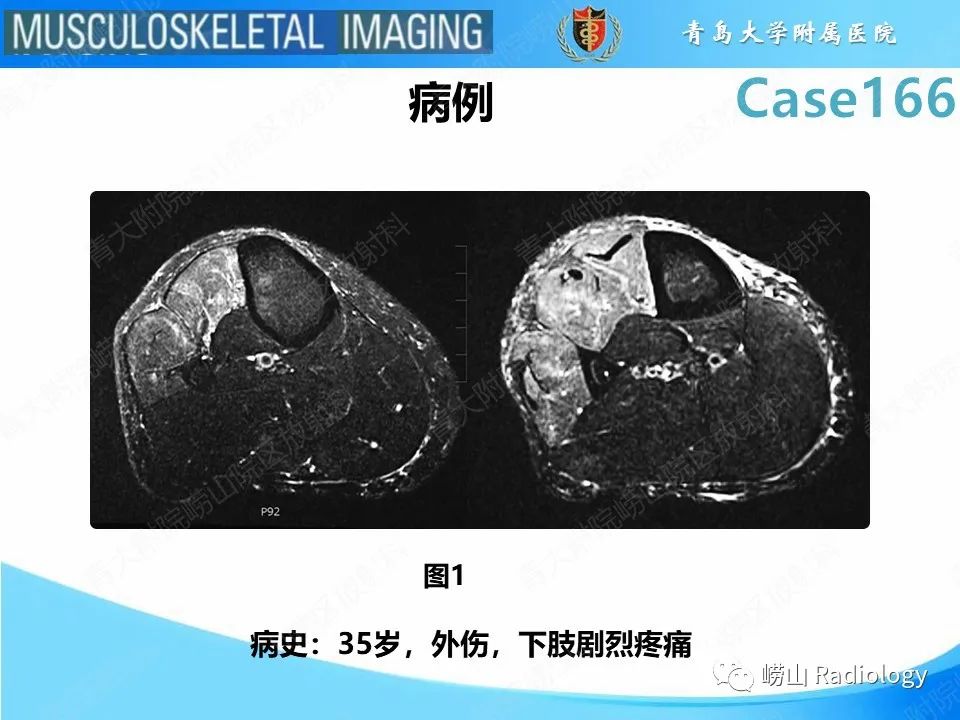 影像PPT - 【PPT】骨筋膜室综合征-2