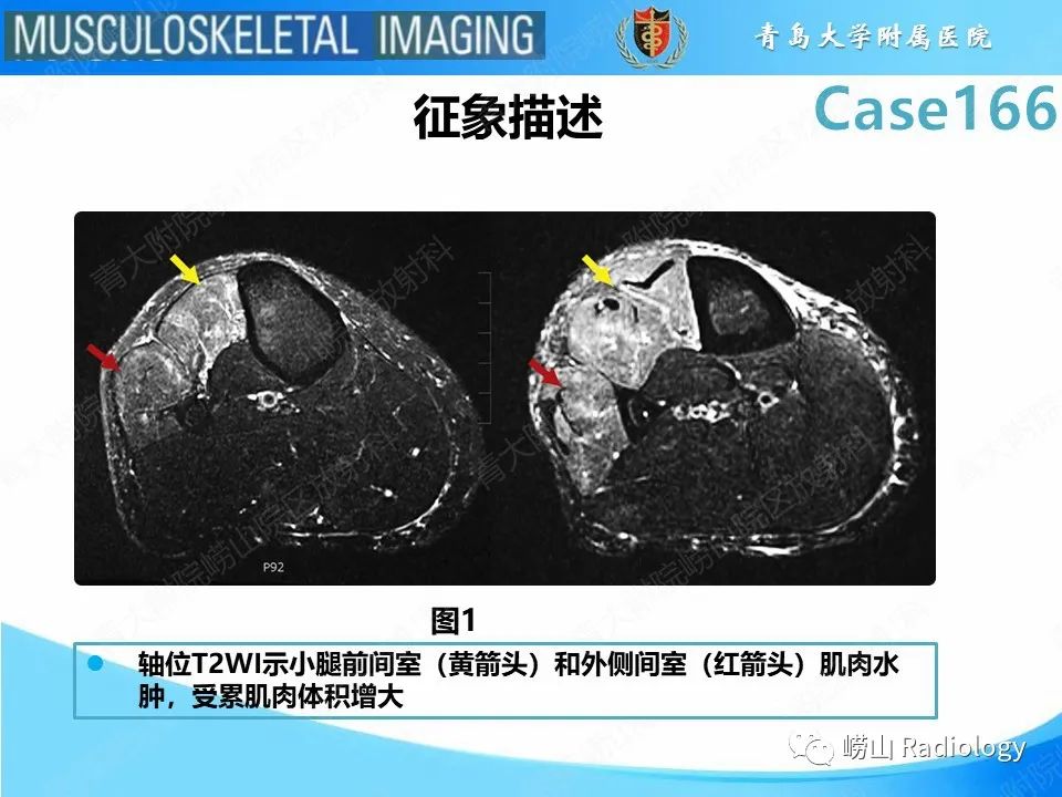 影像PPT - 【PPT】骨筋膜室综合征-11