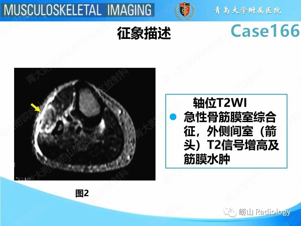 影像PPT - 【PPT】骨筋膜室综合征-12