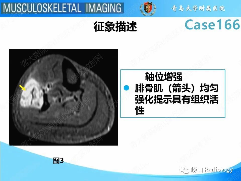 影像PPT - 【PPT】骨筋膜室综合征-13