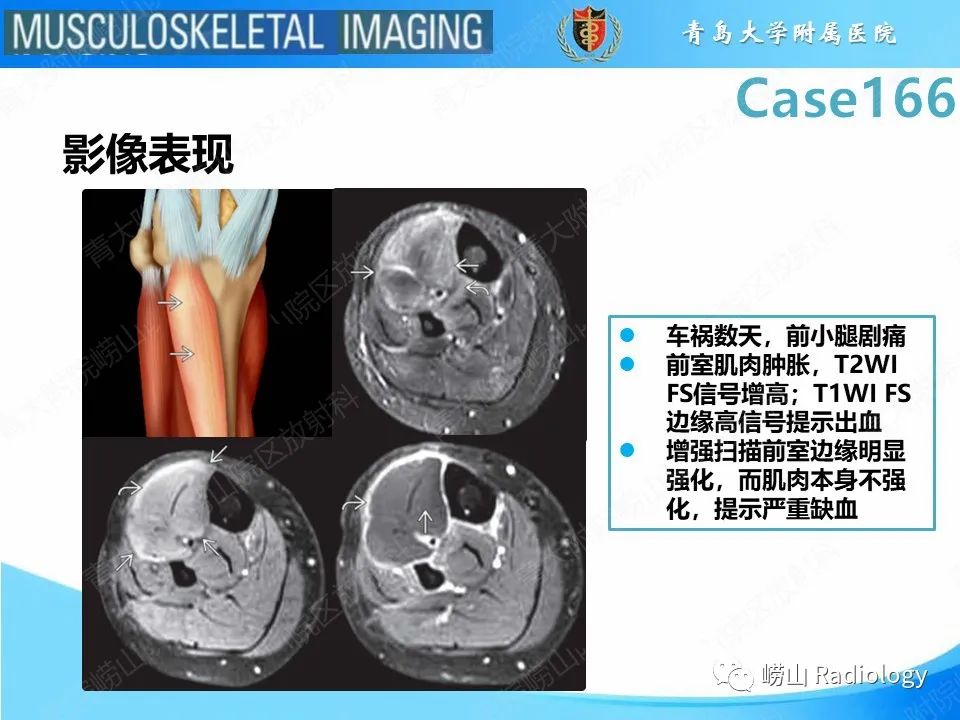 影像PPT - 【PPT】骨筋膜室综合征-20