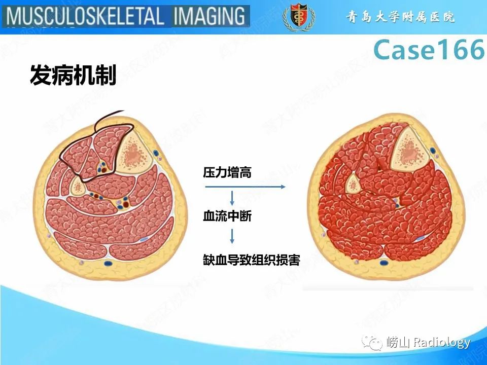 影像PPT - 【PPT】骨筋膜室综合征-16