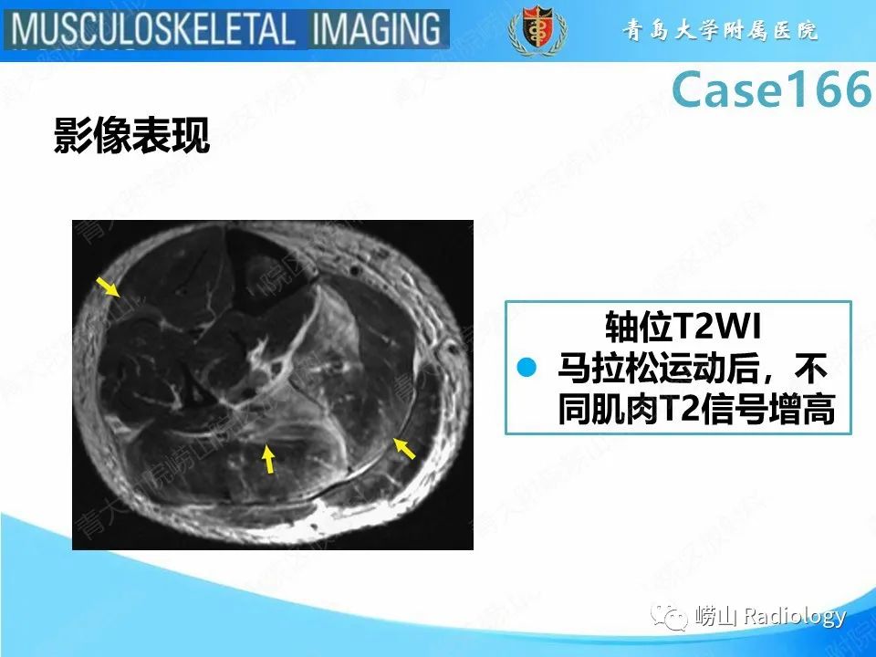 影像PPT - 【PPT】骨筋膜室综合征-23