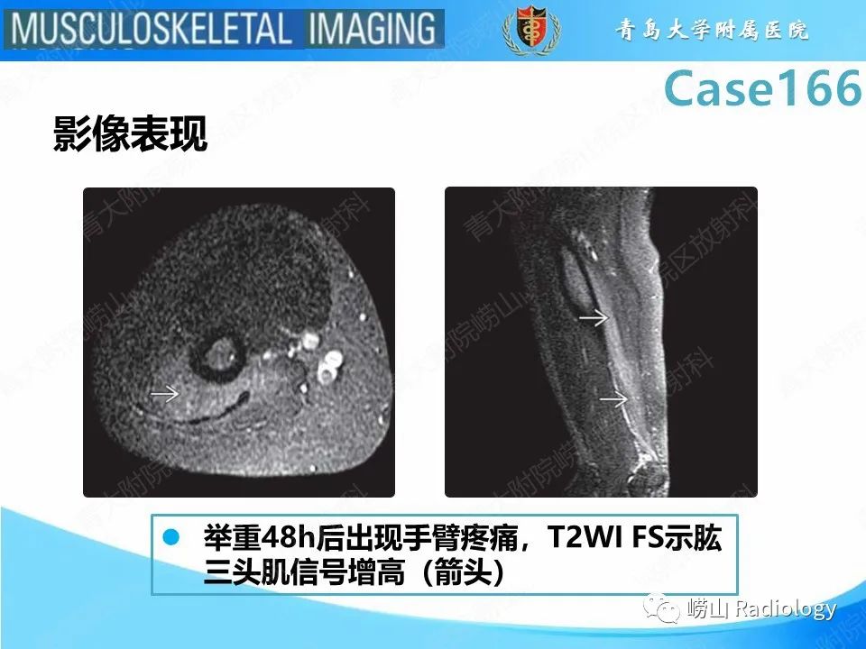 影像PPT - 【PPT】骨筋膜室综合征-24