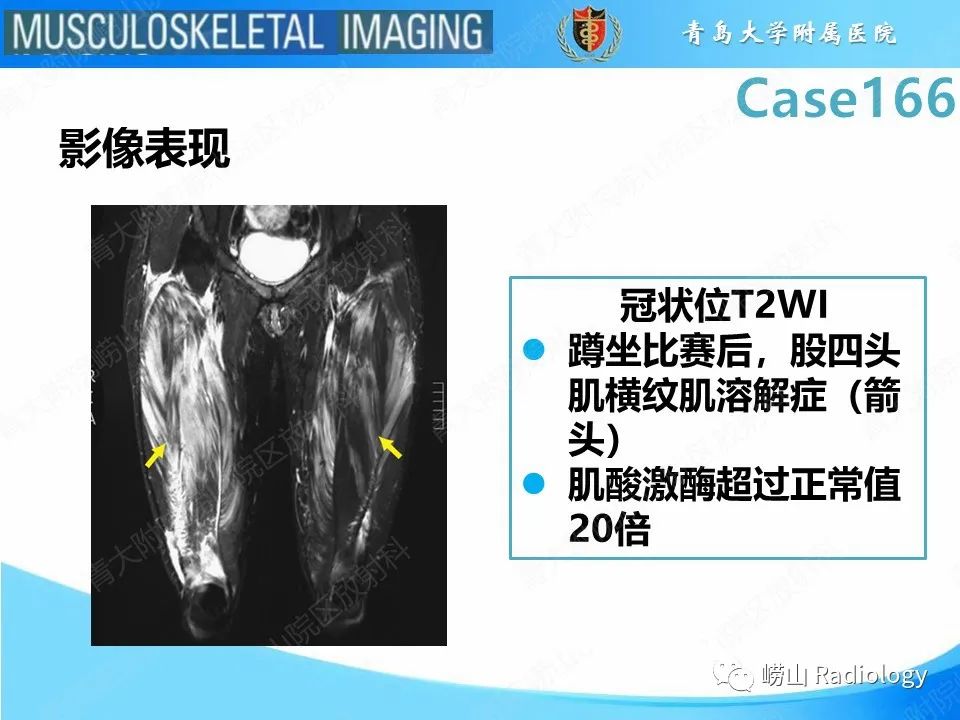 影像PPT - 【PPT】骨筋膜室综合征-26