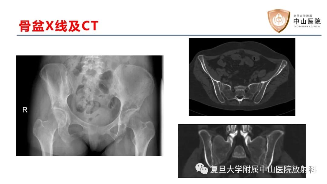 影像PPT - 【病例】肿瘤相关性骨软化症1例X线CT及MR/PET-CT-5
