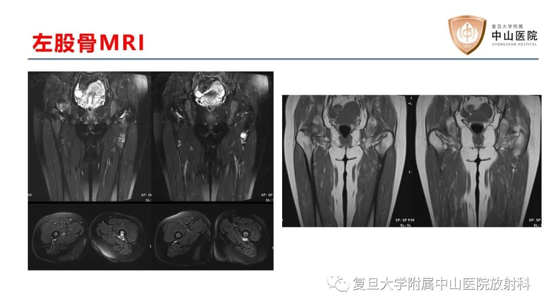 影像PPT - 【病例】肿瘤相关性骨软化症1例X线CT及MR/PET-CT-7