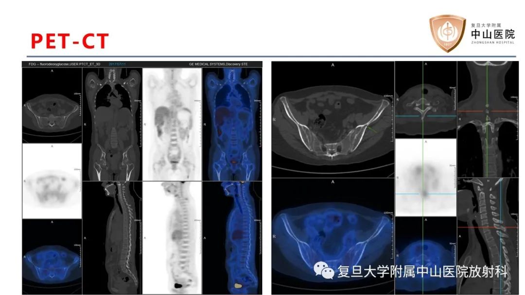 影像PPT - 【病例】肿瘤相关性骨软化症1例X线CT及MR/PET-CT-9