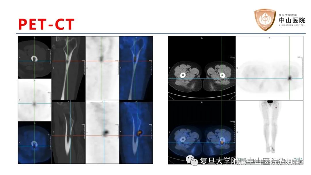 影像PPT - 【病例】肿瘤相关性骨软化症1例X线CT及MR/PET-CT-10