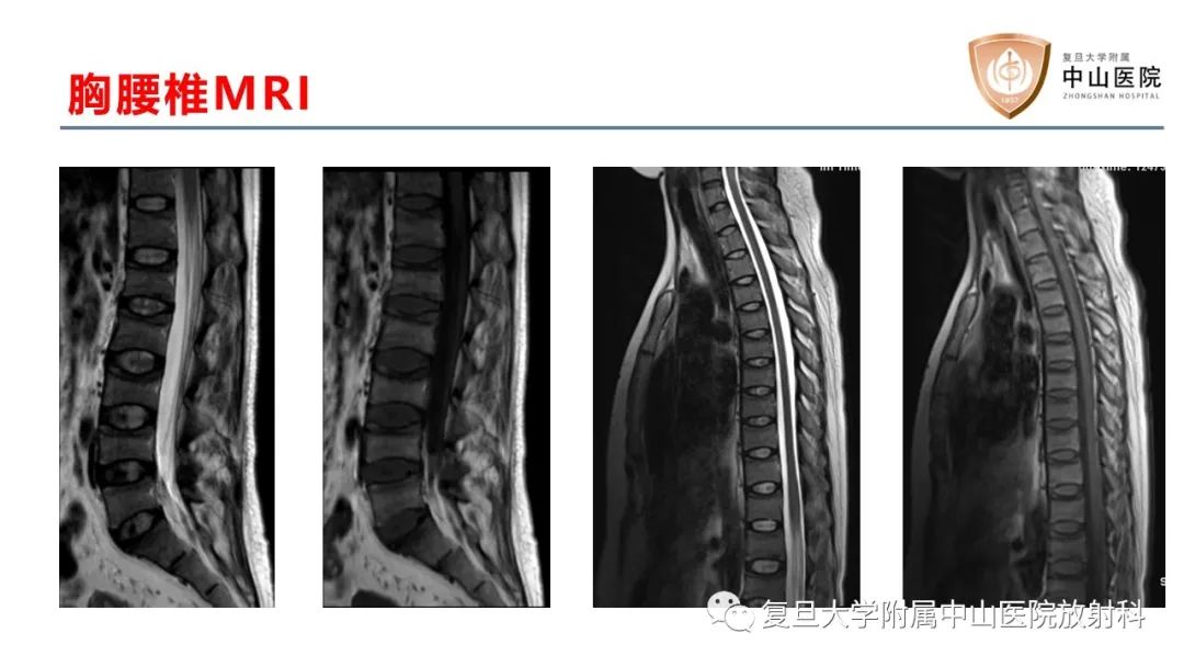 影像PPT - 【病例】肿瘤相关性骨软化症1例X线CT及MR/PET-CT-6