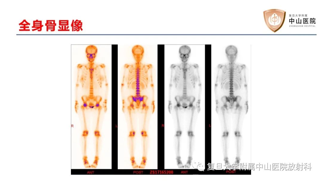 影像PPT - 【病例】肿瘤相关性骨软化症1例X线CT及MR/PET-CT-8