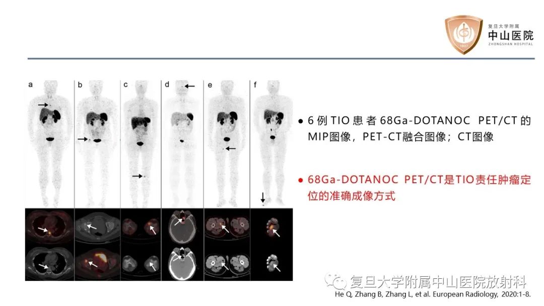 影像PPT - 【病例】肿瘤相关性骨软化症1例X线CT及MR/PET-CT-22