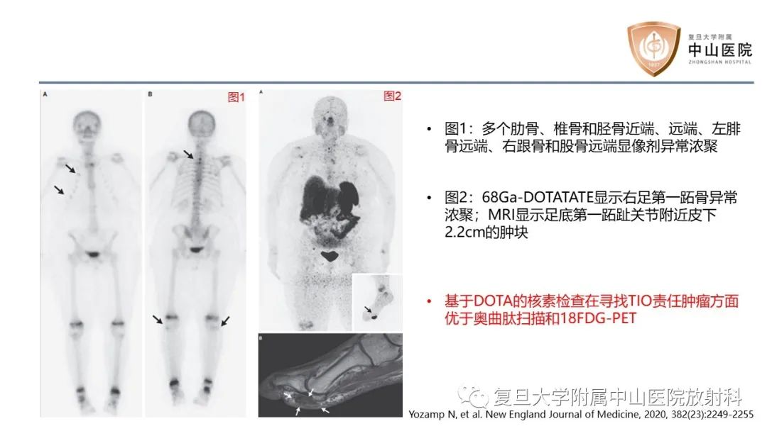 影像PPT - 【病例】肿瘤相关性骨软化症1例X线CT及MR/PET-CT-23