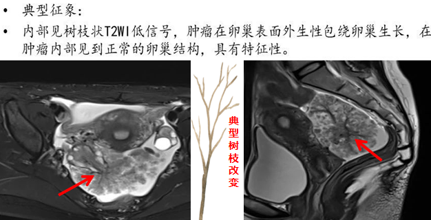 影像PPT - 【病例】卵巢交界性乳头状囊腺瘤1例CT及MR-13 影像PPT - 【病例】卵巢交界性乳头状囊腺瘤1例CT及MR-13