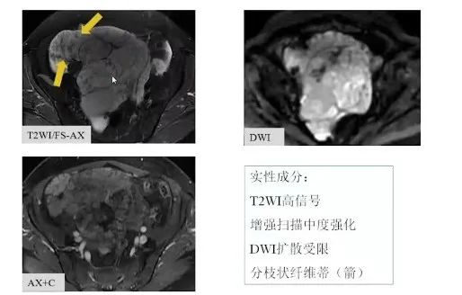 影像PPT - 【病例】卵巢交界性乳头状囊腺瘤1例CT及MR-15 影像PPT - 【病例】卵巢交界性乳头状囊腺瘤1例CT及MR-15