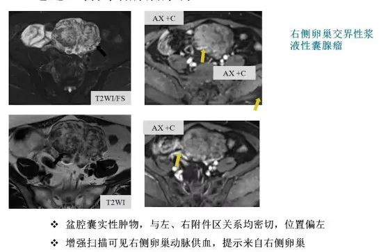 影像PPT - 【病例】卵巢交界性乳头状囊腺瘤1例CT及MR-18 影像PPT - 【病例】卵巢交界性乳头状囊腺瘤1例CT及MR-18