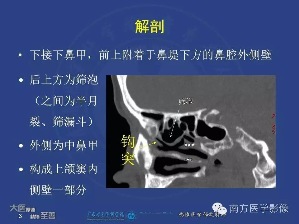 影像PPT - 【PPT】钩突（Uncinate process）解剖及变异-3