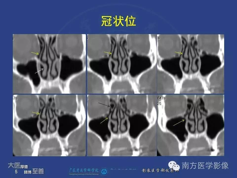 影像PPT - 【PPT】钩突（Uncinate process）解剖及变异-5