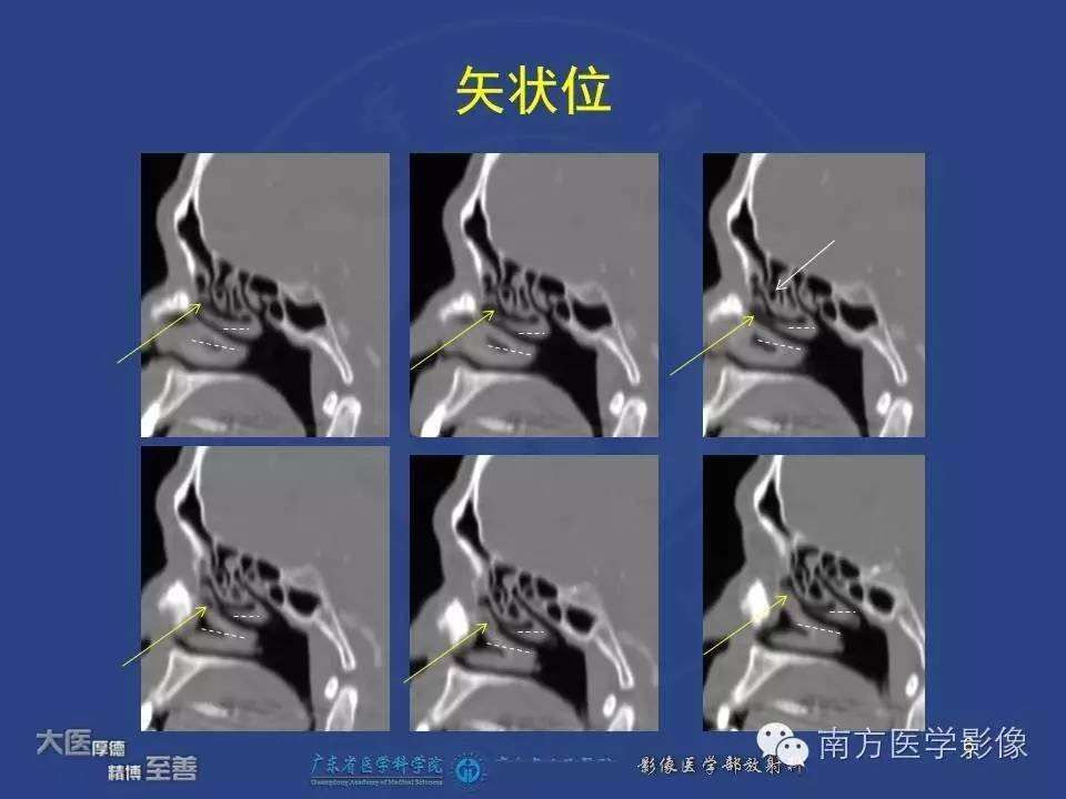 影像PPT - 【PPT】钩突（Uncinate process）解剖及变异-6