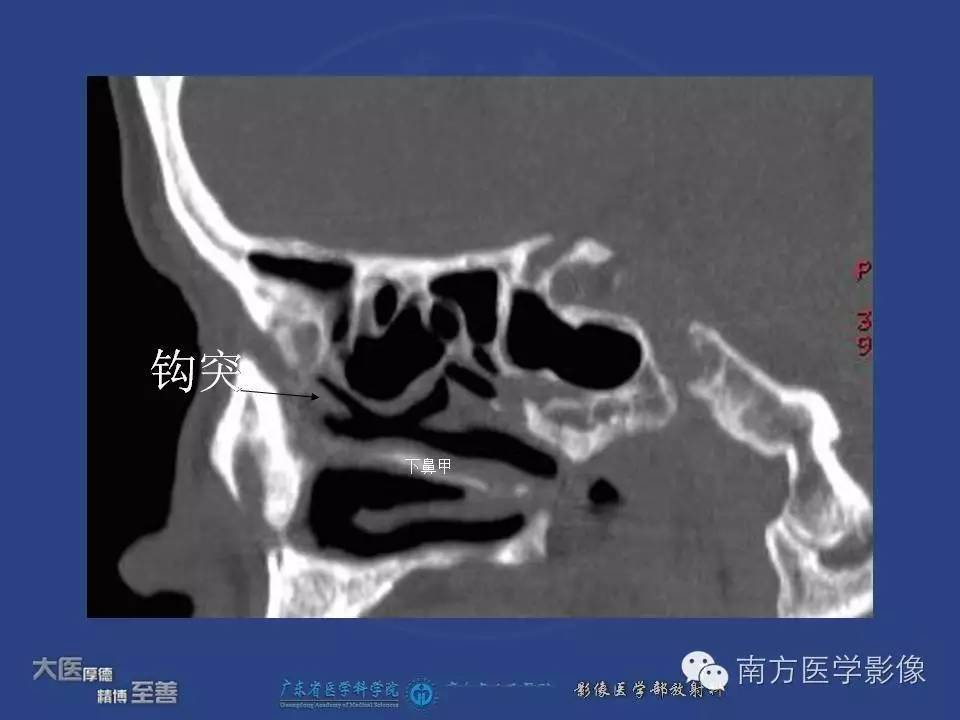 影像PPT - 【PPT】钩突（Uncinate process）解剖及变异-7
