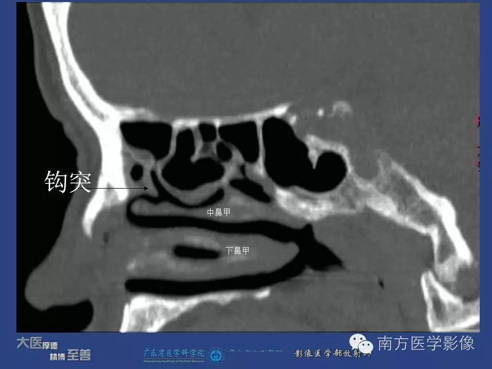 影像PPT - 【PPT】钩突（Uncinate process）解剖及变异-8