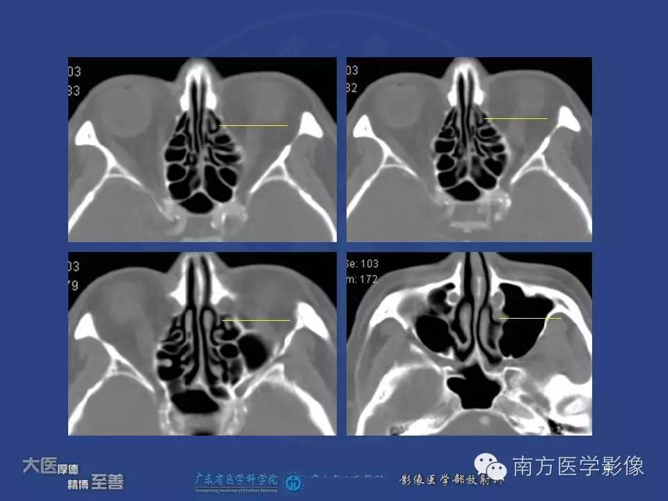 影像PPT - 【PPT】钩突（Uncinate process）解剖及变异-4