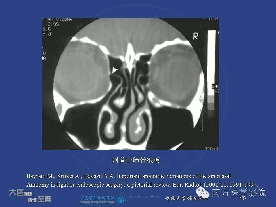 影像PPT - 【PPT】钩突（Uncinate process）解剖及变异-10