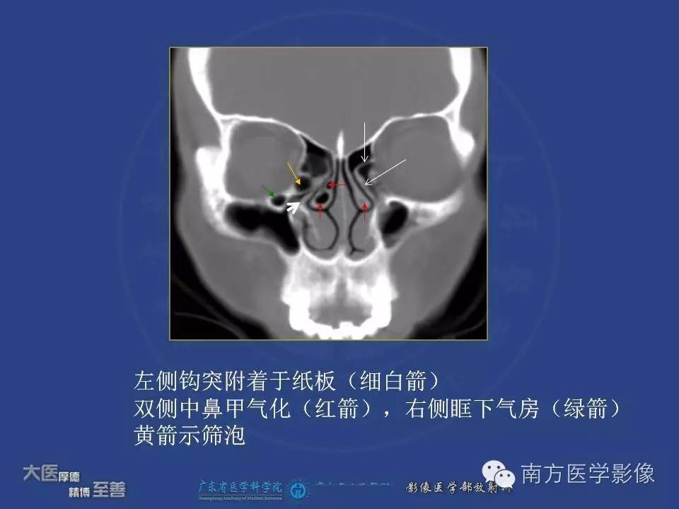 影像PPT - 【PPT】钩突（Uncinate process）解剖及变异-11